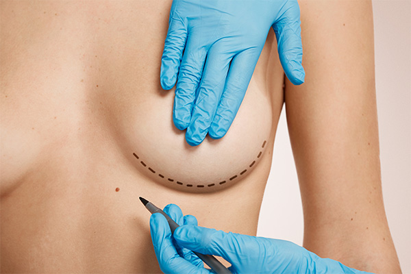 Breast Reduction Surgery: Medical Indications, Procedure & Recovery
